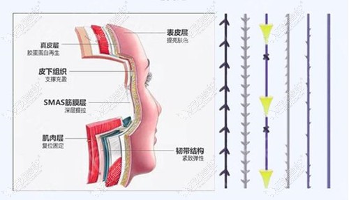 青春支架和埋线提升区别