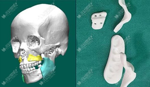 3D导板正颌手术技术