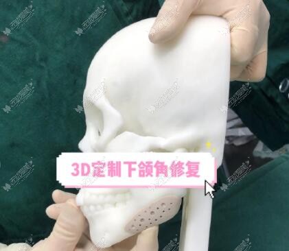 3d人工骨修补下颌骨