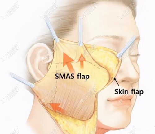 大拉皮手术的剥离的层次相对较深