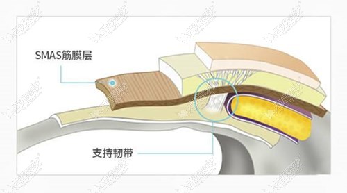 面部下垂厉害的要做韧带提升价格就会高一些