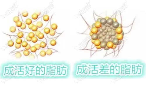 脂肪填充细胞成活性决定维持时间