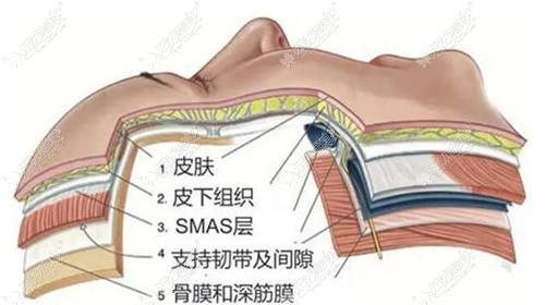 武汉美莱拉皮手术价格