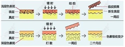 激光去除黑色素沉淀原理