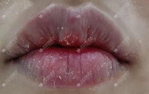 到了冬天老是有唇炎的问题,怎么治疗才能根断呢（护理篇）