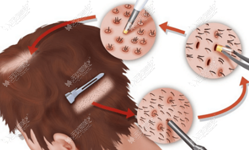 沈阳碧莲盛fue微针植发过程