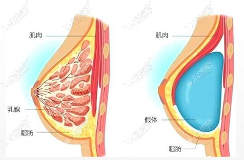 沈正宇隆胸怎么样呢