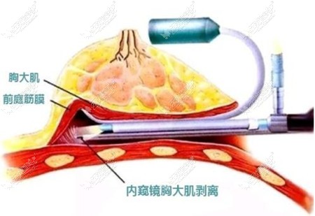 本期南京隆胸医生排名:做假体隆胸有内窥镜技术推荐这几位