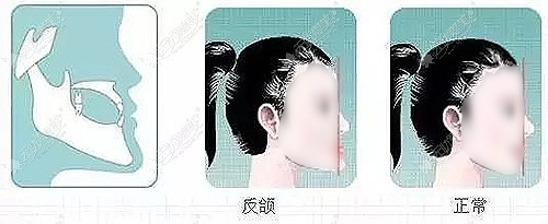 方脸+反颌做双鄂手术