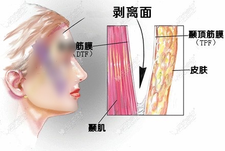 大拉皮手术操作过程和原理