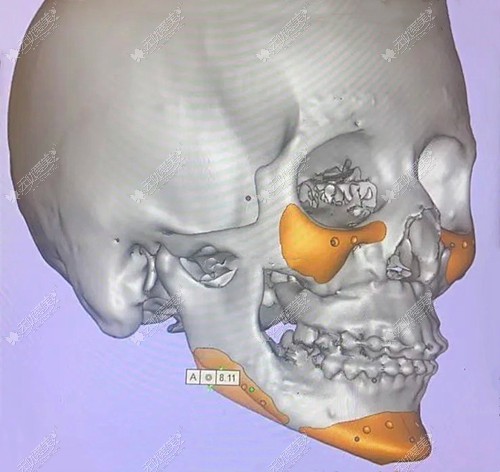 3d打印人工骨修复下颌角的成效图