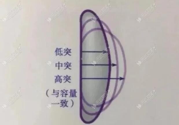 星熠高凸和中凸的区别