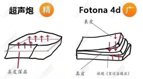 超声炮和欧洲之星功效不同