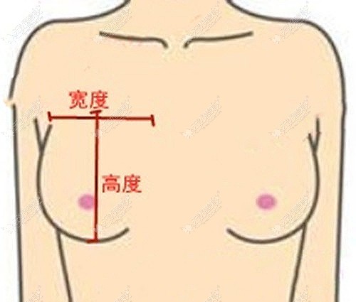 隆胸假体中凸和高凸怎么选