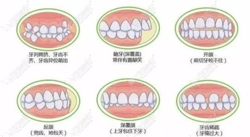 错颌畸形的种类