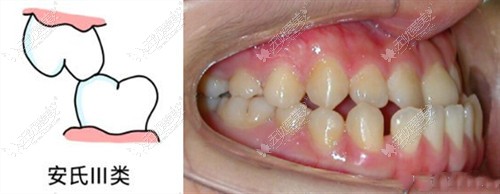 安氏Ⅲ类错颌