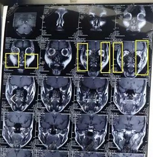 脸部核磁共振图片