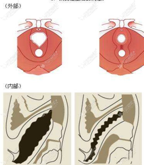 阴道紧缩手术的原理