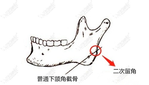普通下颌角截骨手术成效
