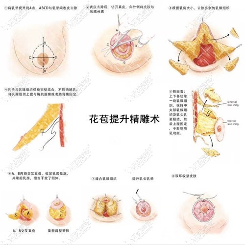 花苞精雕术就是双环法吗听完这俩的区别再决定用哪种缩胸