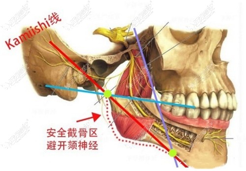 超长曲线截骨手术过程