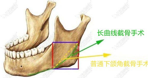 下颌角截骨和长曲线截骨区别