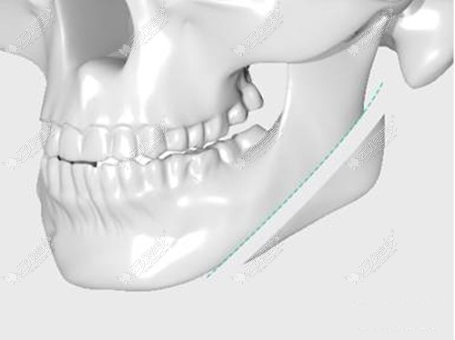 下颌角截骨手术方式