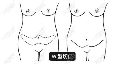 腹壁成型术w型切口图片
