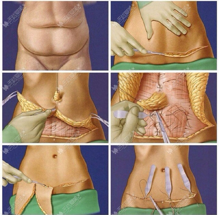 腹壁成型手术过程