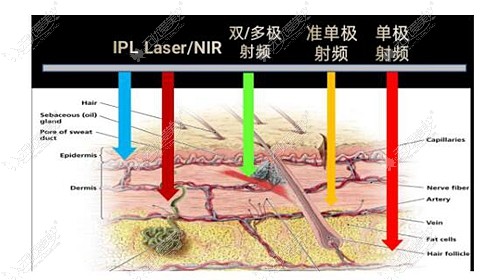 黄金热拉提2.0和热拉提plus的区别