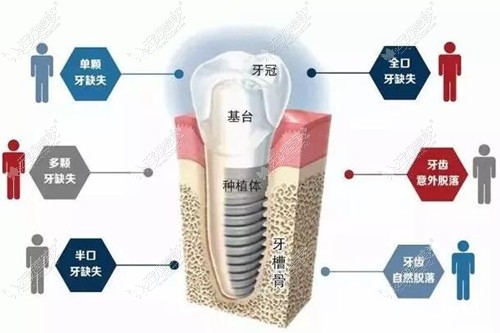 种植牙的适合人群