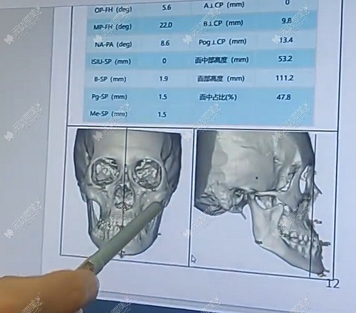 正颌手术过程图