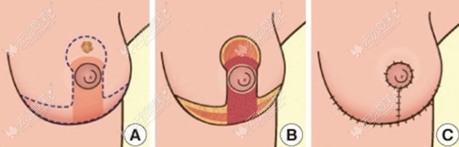 缩胸手术选倒T和棒棒糖法哪个好?两个术式的切口区别还挺大