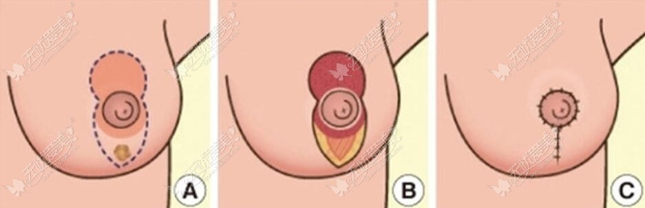 乳房缩小棒棒糖手术切口图片