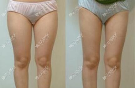 大腿抽脂术后3个月对比图