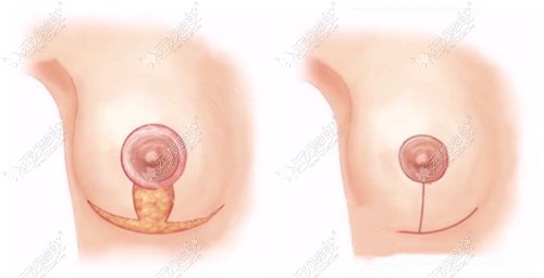 乳房下垂做棒棒糖切口手术图片证实,并没有留疤和增生哦