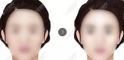 做3D织网面部提升脸会变宽吗?担心出现脸变大显老的后遗症