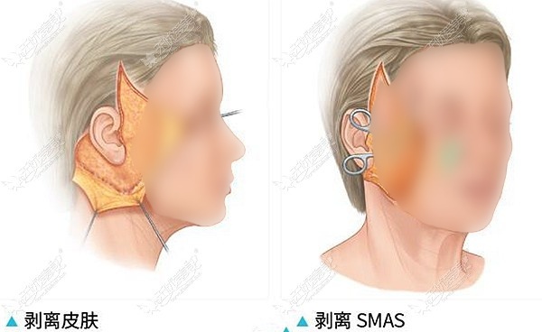 高位smas筋膜面部提升和拉皮的区别