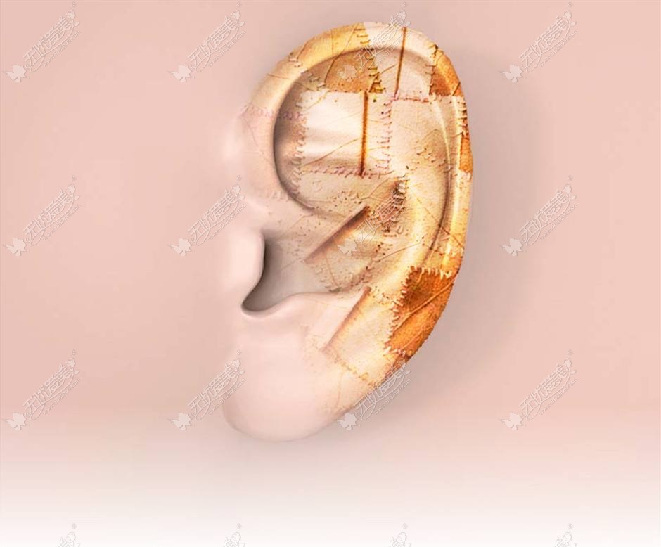 小耳再造是直埋法好还是注水扩张好?区别是手术方法不同