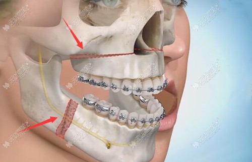 地包天正颌手术过程图解