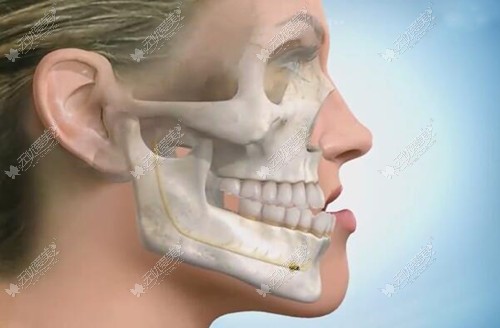 地包天做正颌手术过程图解:手术痛苦程度高但脸型改变挺大