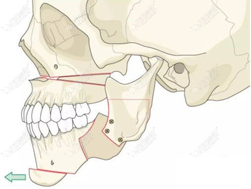 地包天正颌手术痛苦程度大