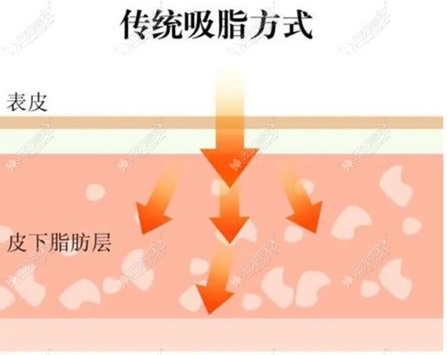 快乐吸脂和传统吸脂哪个好?从疼痛感和价格上来对比