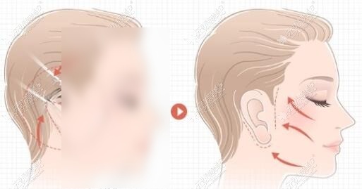拉皮手术原理 拉皮手术原理