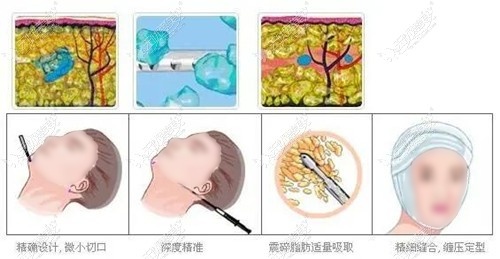 面部抽脂的手术过程 面部抽脂的手术过程