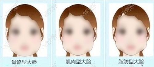 面部抽脂一般抽多少毫升呢?其实抽40ml、50ml、70ml都不算多