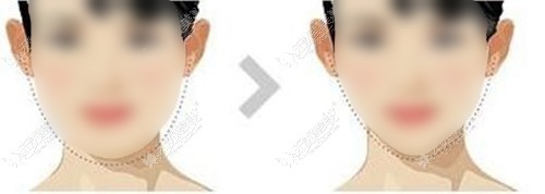 面部吸脂前后对比图 面部吸脂前后对比图