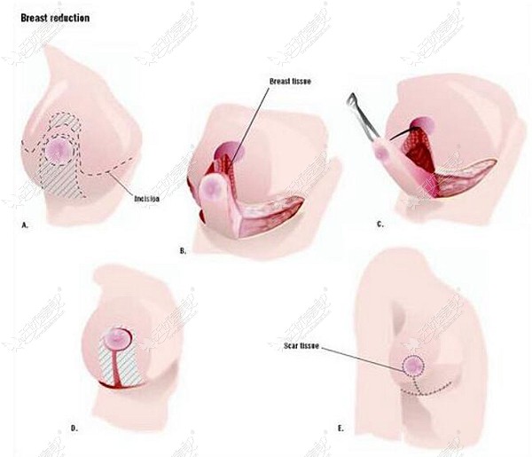 缩胸手术原理图