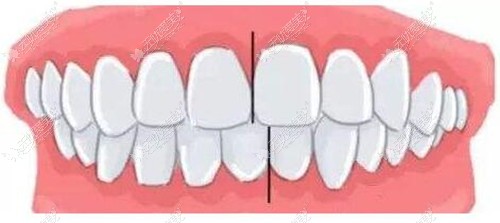 骨性偏颌和牙性偏颌的区别是什么?手术方案和价格上有不同