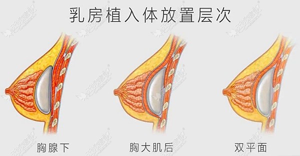 假体隆胸的植入层次